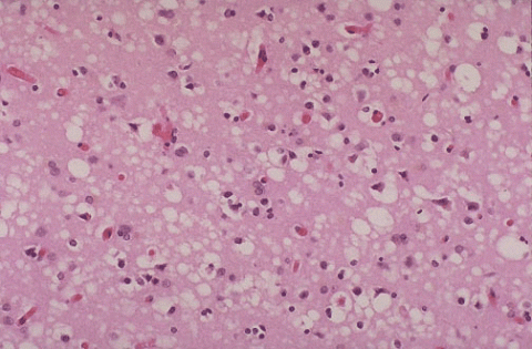 cjd cells