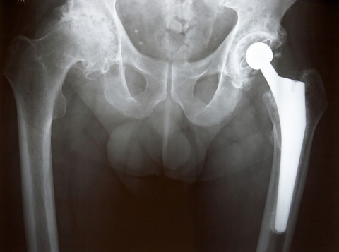 best hip replacement hospital