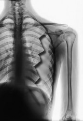 rib removal