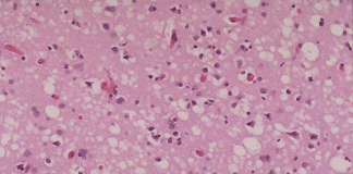 cjd cells