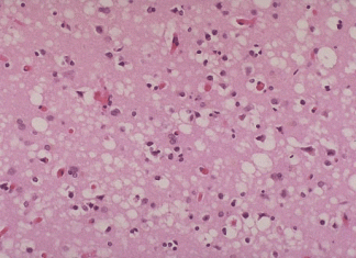 cjd cells