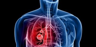 lung cancer