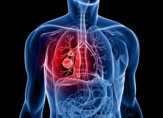 lung cancer