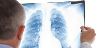 Lung Cancer Screenings