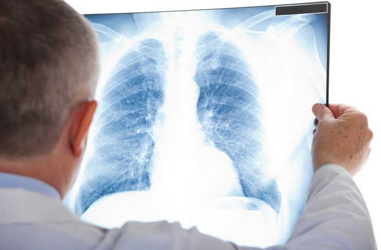 Lung Cancer Screenings